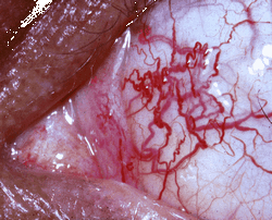 Ataxia-telangiectasia1.gif