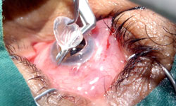  Apply New Corneal Transplant Technique Cuban Ophthalmologists