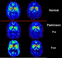 En la Habana Existen siete millones de enfermos de Parkinson en el mundo