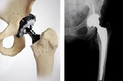 Cuba Implants Over 6000 Prosthesis of RALCA Hip