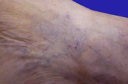 Treatment against varicose veins
